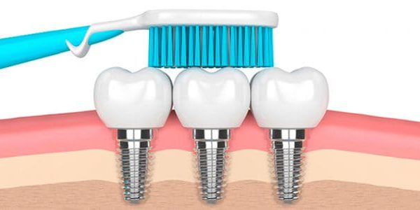 Cómo cuidar tus implantes dentales