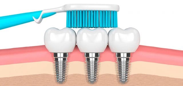 Cómo cuidar tus implantes dentales