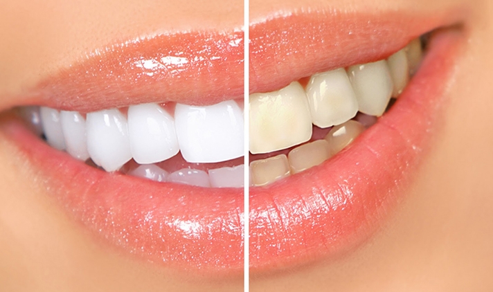 Blanqueamiento dental