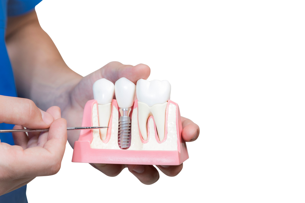 Implantes dentales