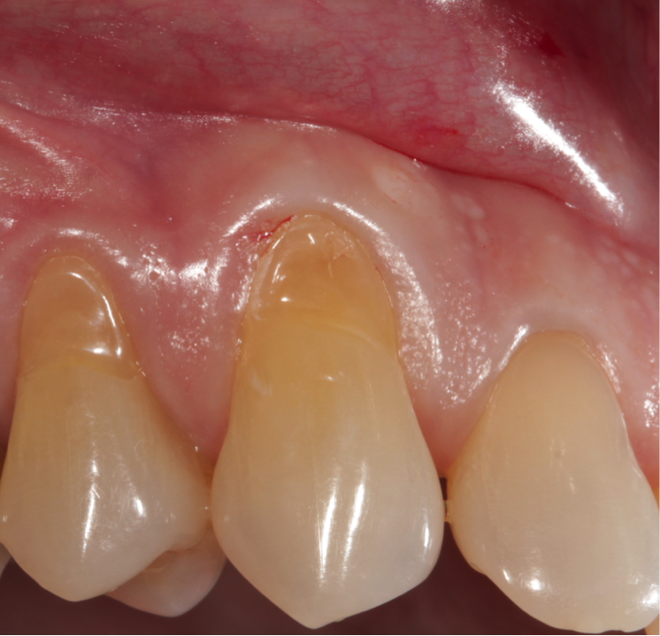 Desgaste dental por cepillado dental agresivo